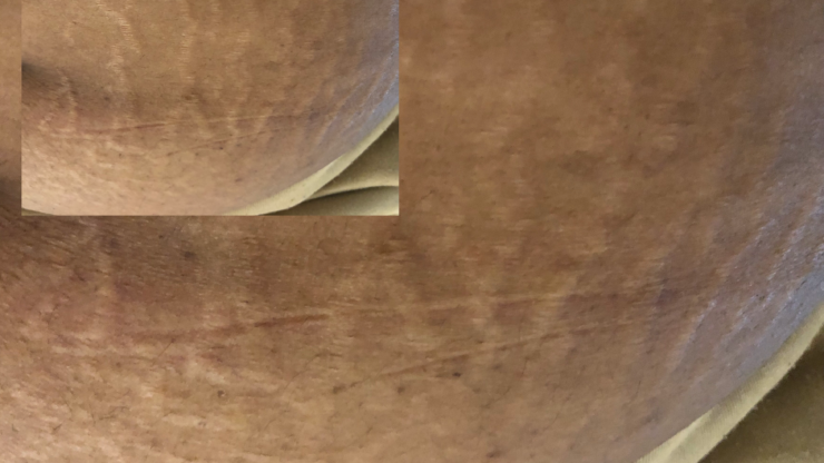 Camouflage des vergetures et cicatrices